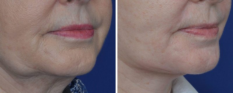 Annapolis Chin Implants Before and After Photo