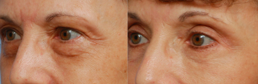 Annapolis Eyelid Surgery Before & After