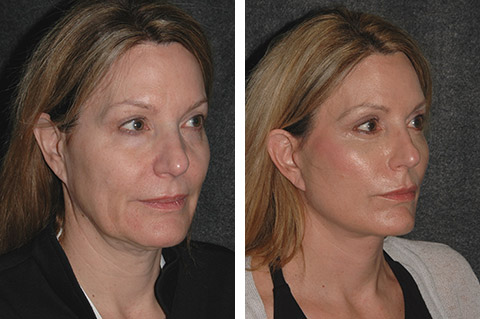 Annapolis Facelift Before & After Photo