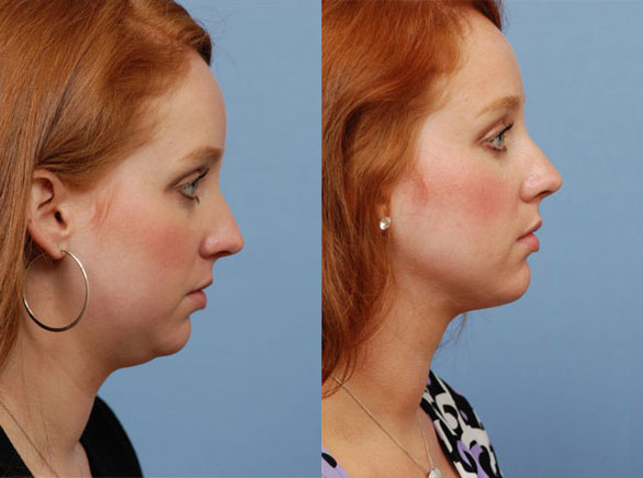 Chin Implant Before & After by Annapolis Plastic Surgeon