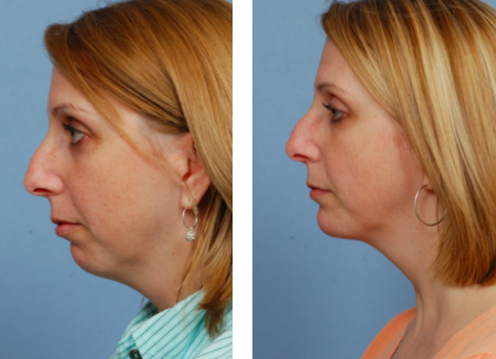 chin-implant