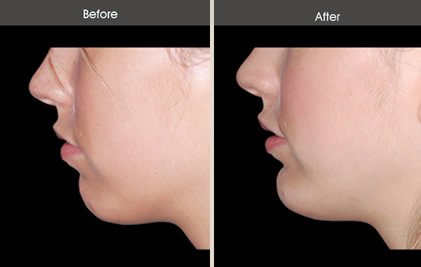 chin implant