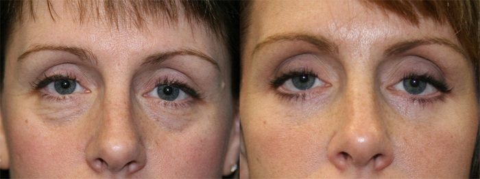 Lower Eyelid Surgery