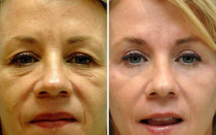 Non-surgical Eyelid Rejuvenation Annapolis Md