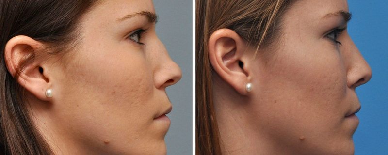 Nose Reshaping Before & After by Annapolis Plastic Surgeon