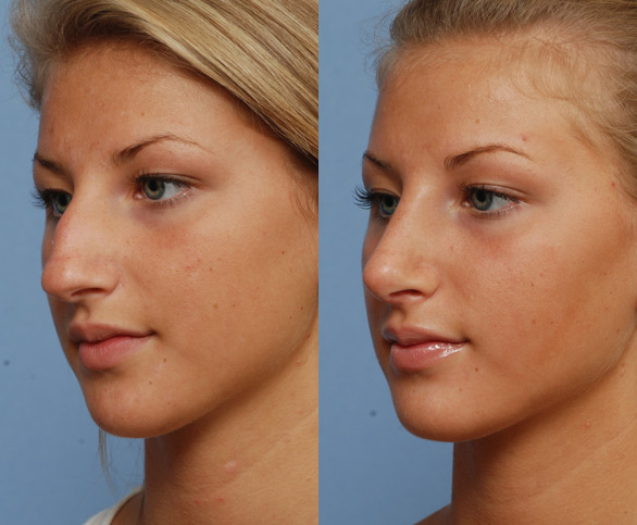 Rhinoplasty